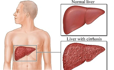 Cirrhosis of liver